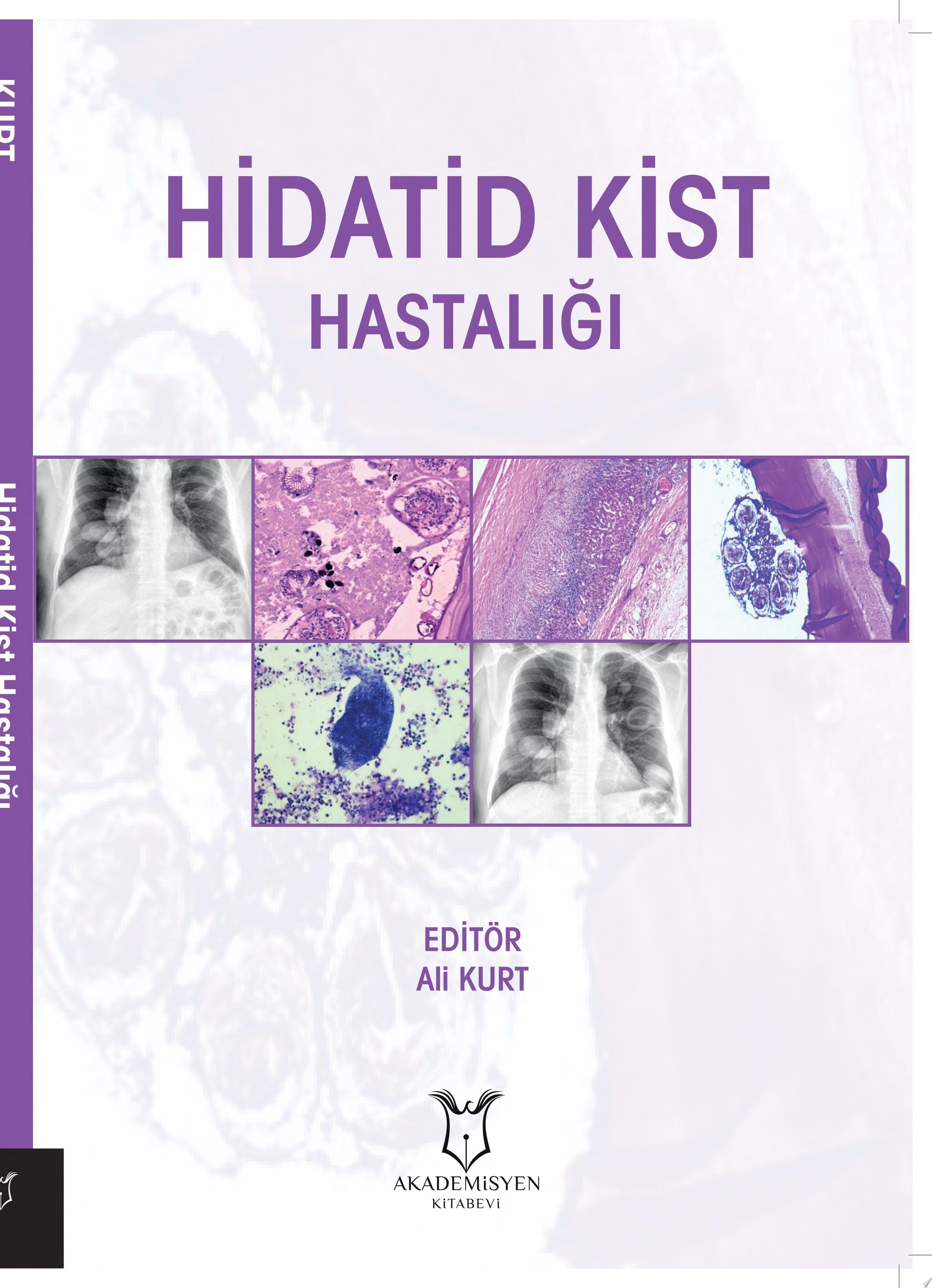 Hidatid Kist Hastalığı