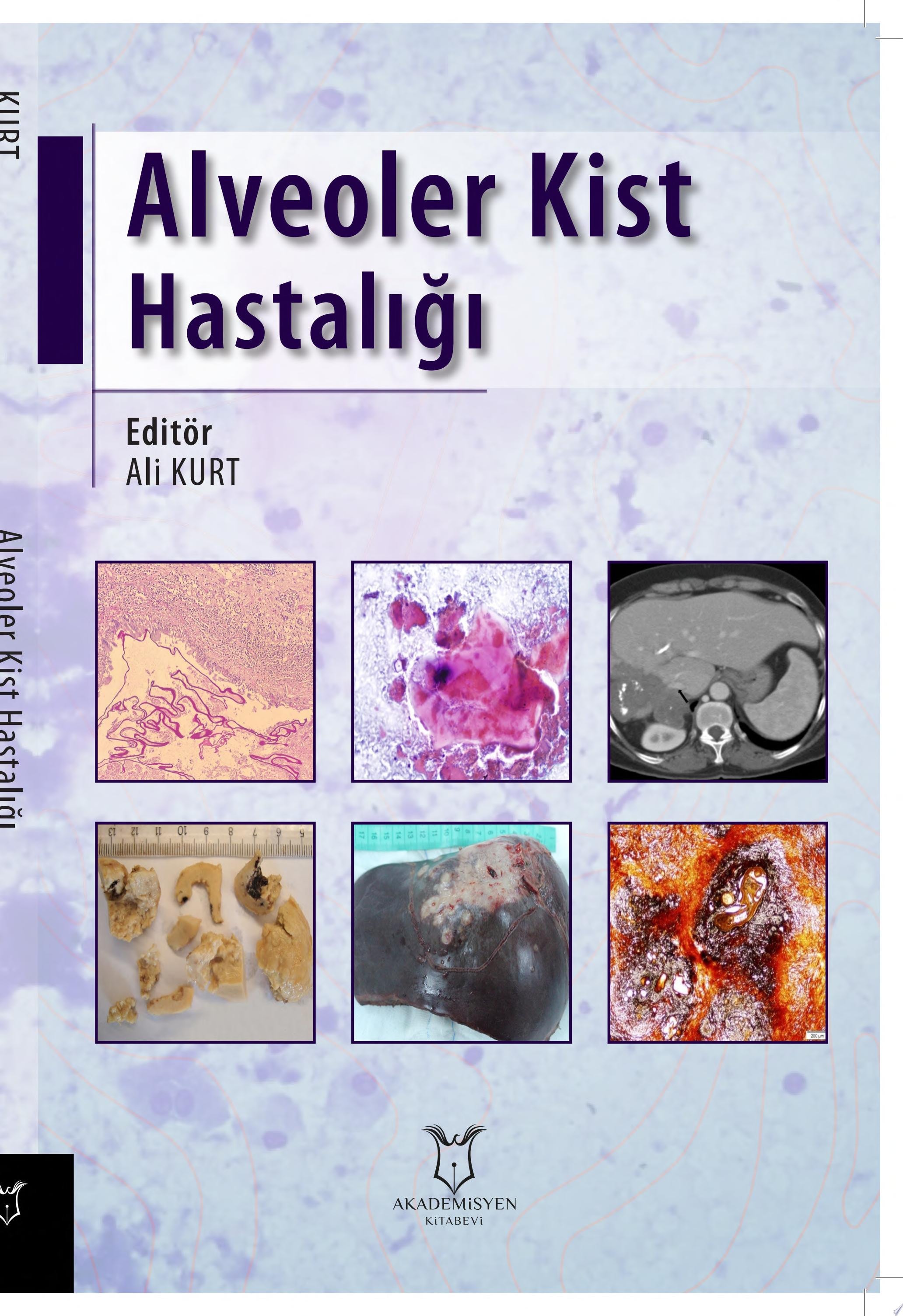 Alveoler Kist Hastalığı